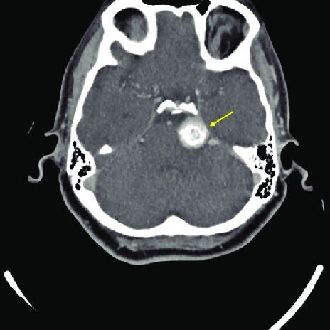 Axial computed tomography angiogram image of the brain at the level of ...