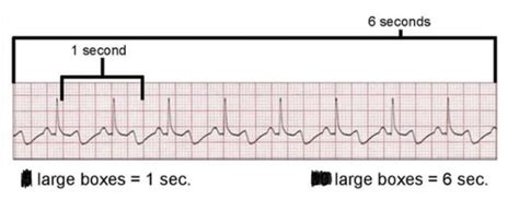 Ekgs Flashcards Quizlet