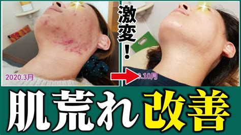 【肌荒れ改善】人生変わる！即効でニキビや肌荒れを治す超・肌荒れ改善術【高級化粧品不要】 Youtube