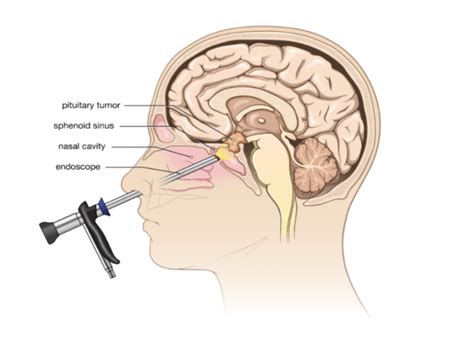 Why do Some People Require Nasal and Sinus Surgery? – FAQs – Best ENT ...