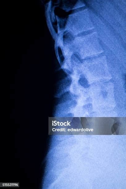 척추 척추뼈 등근육 부상 X선 검사 건강 진단에 대한 스톡 사진 및 기타 이미지 건강 진단 건강관리와 의술 과학 Istock