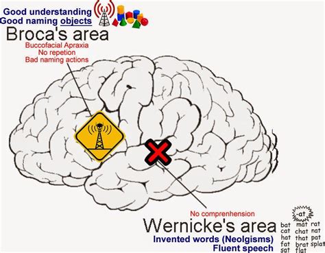 Medical Mindmaps For Usmle Step 1 Brocas And Wernickes Aphasia Aphasia Usmle Step 1