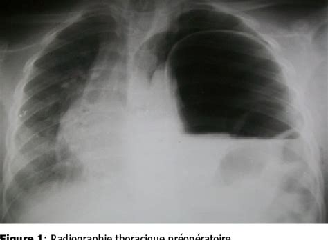 Figure 1 from Hernie diaphragmatique post traumatique de lenfant à