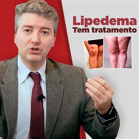 Como Acabar Com O Lipedema - Lipedema: o que é e como tratar o acúmulo de gordura nas pernas