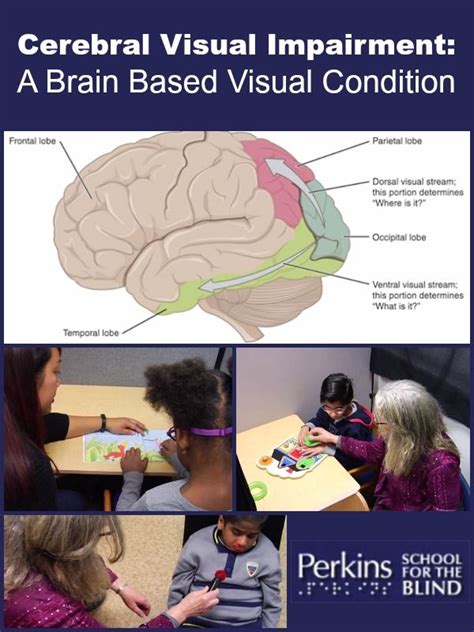 Cerebral Visual Impairment A Brain Based Visual Condition Perkins