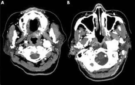 Contrasted Axial Computed Tomography Scan A At The Level Of The Atlas