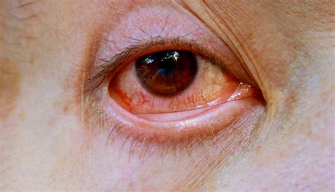 Giant Papillary Conjunctivitis Causes Symptoms And Treatment Accuspire