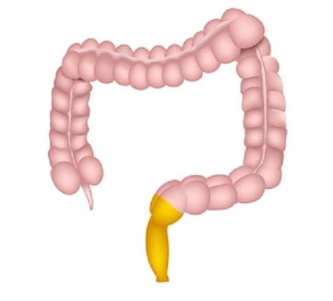 Proktitis Patofisiologi Diagnosis Penatalaksanaan Alomedika