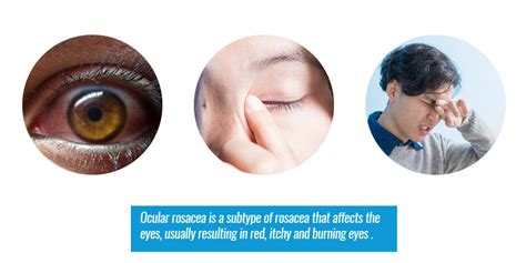 Ocular Rosacea: Causes and Treatment Options - Cliradex®