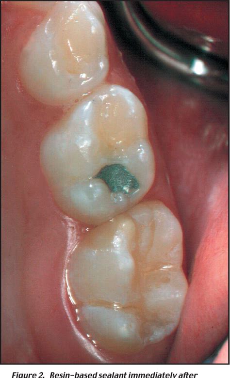 Pdf Effectiveness Of A Glass Ionomer Cement Used As A Pit And Fissure