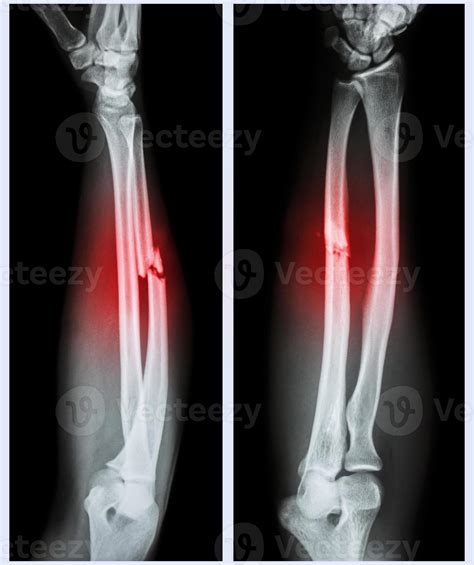 Fractura Conminuta Del Eje Del Hueso Cubital 949997 Foto De Stock En