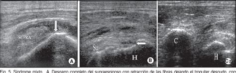 Figure From Valor Del Ultrasonido De Hombro En El S Ndrome De