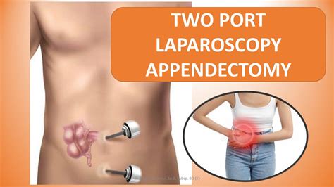 TWO PORT LAPAROSCOPY APPENDECTOMY LAPAROSCOPY USUS BUNTU DENGAN DUA