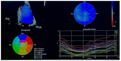 4dimensional Xstrain Echocardiography M Mode And Tissue Doppler Estimation Of Age And Gender