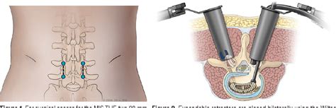 Figure From Evolution Of Minimally Invasive Transforaminal Lumbar