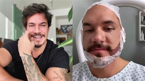 Ex Bbb Eliezer Fez Transplante De Cabelo E Barba Saiba Quanto Custa