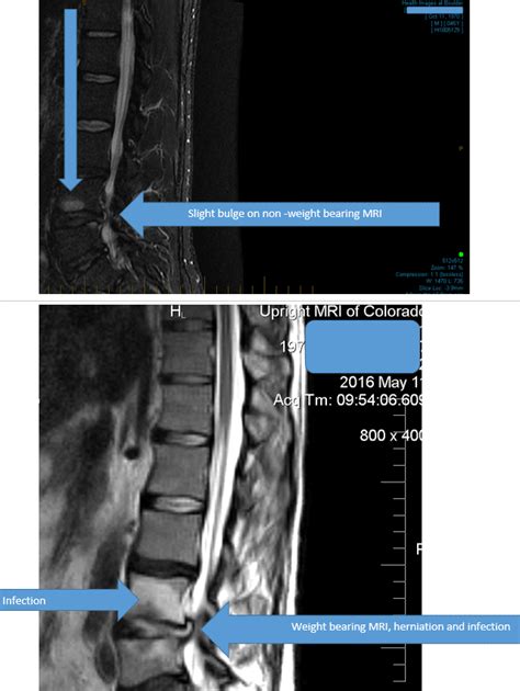 Upright Vs Supine MRI With Post Infection After Surgery