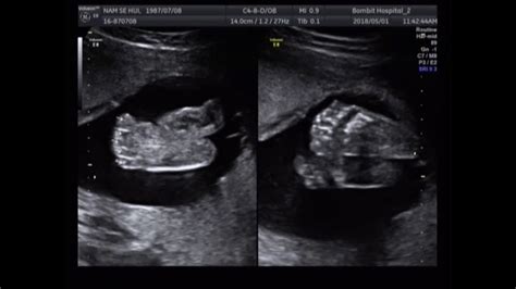 21 Weeks Pregnant Ultrasound Gender