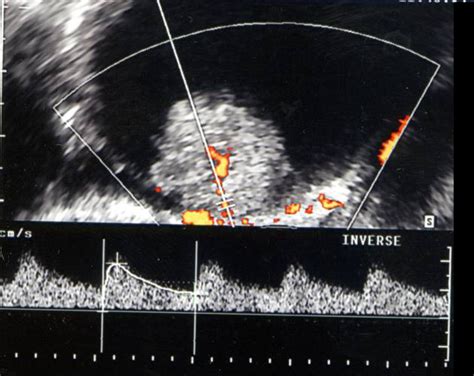 Icono 50 Echographie Des Ovaires