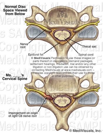 Osteophytes