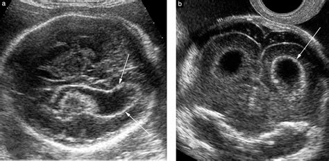 Subarachnoid Space Hemorrhage Ultrasound