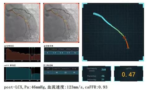 Caffr为复旦大学附属中山医院吴淞医院提供准确冠脉功能评估，引导精准介入治疗苏州润迈德医疗科技有限公司caffrcaimr介入手术机器人