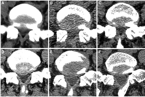 Integrity of the ligamentum flavum on computed tomography before and... | Download Scientific ...