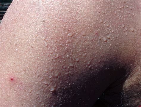 Prickly Heat Rash Pictures