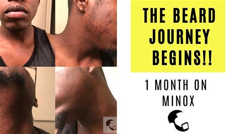 Growing A Beard With Minoxidil A Black Mans Experience 1 Month In