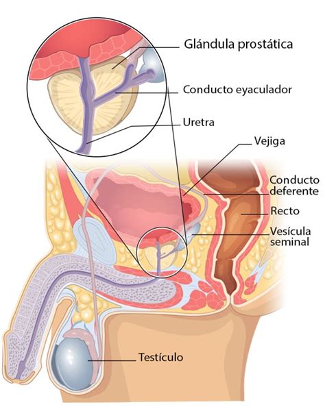 ¿qué Es El Cáncer De Próstata Cdc