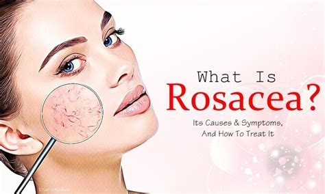 What Is Rosacea Its Causes And Symptoms And How To Treat It