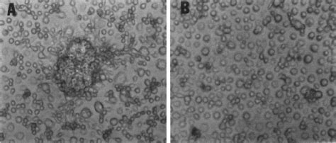 M Abscessus R Infection Of Human Monocytes Is Associated With The