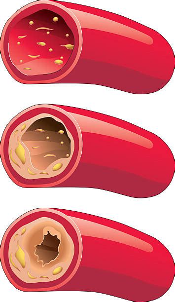 Arteriosclerosis Illustrations Royalty Free Vector Graphics And Clip Art