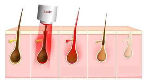 Depilação A Laser Conheça Seus Tipos Benefícios E Preço