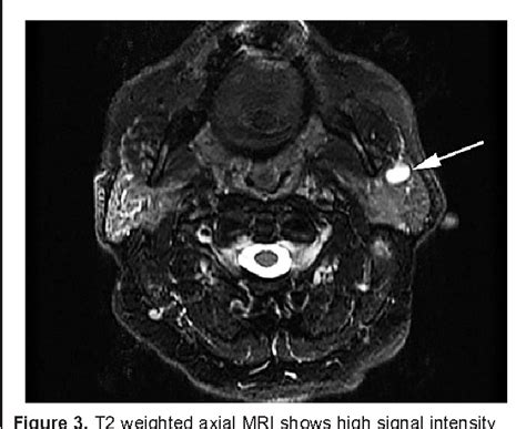 Figure 3 From A Case Of Synchronous Unilateral Parotid Tumors Of