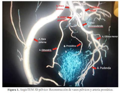 Eficacia De La Embolizaci N De Las Arterias Prost Ticas En El