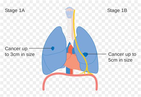 Lung Cancer Stages Diagram, HD Png Download - vhv