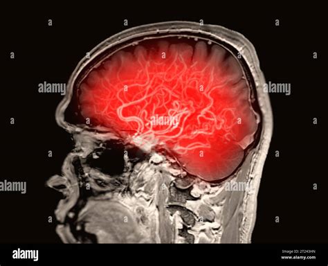 Mri Brain Fusion With Mri Mra Brain For Evaluate Them Stenosis And