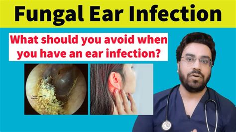 Antibiotic Ear Drops For Fungal Infection | informacionpublica.svet.gob.gt