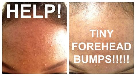 How To Get Rid Of Tiny Forehead Bumps Forehead Acne Forehead