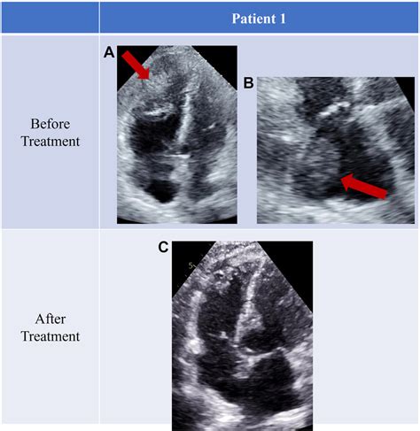 Transthoracic Echocardiogram Of Patient 1 Before Top Row And After