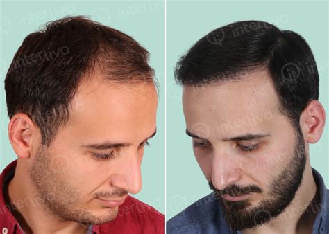 Hair Transplant Before And After Photos Interliva Hair