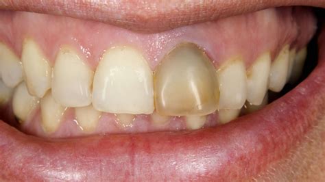 Black Stains On Teeth Causes And Treatment In Bassendean