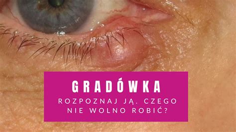 Gradówka Na Powiece Rozpoznaj Ją Czego Nie Wolno Robić