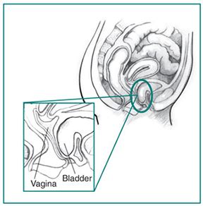 Prolapsed Bladder Surgery | Columbus Regional Health