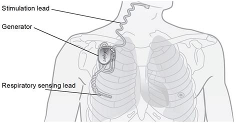 Hypoglossal Nerve Stimulation Enhanced Dental Cpd Online