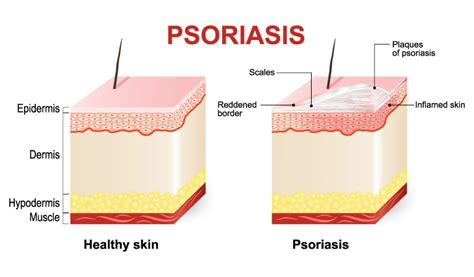 Psoriasis triggers that cause eruption - Dr Batra’s®