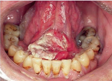 Squamous Cell Carcinoma Of Floor Of Mouth Medizzy