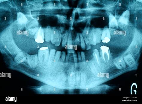 ANKYLOSIS TOOTH XRAY Stock Photo - Alamy