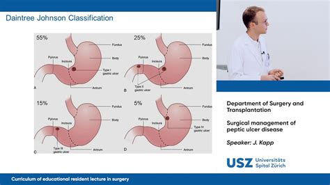 Peptic Ulcer Max Intervention Images